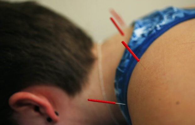 Acupuncture And The Many Ways It Can Help Daily Pain